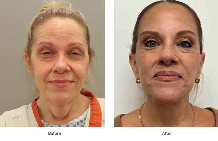 neck lift 1