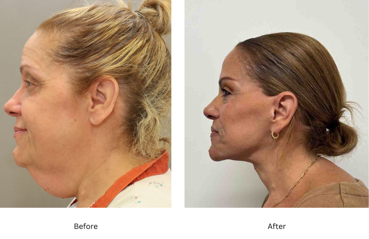 neck lift 2
