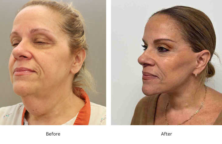 neck lift 3