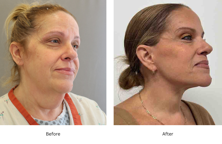 neck lift 4