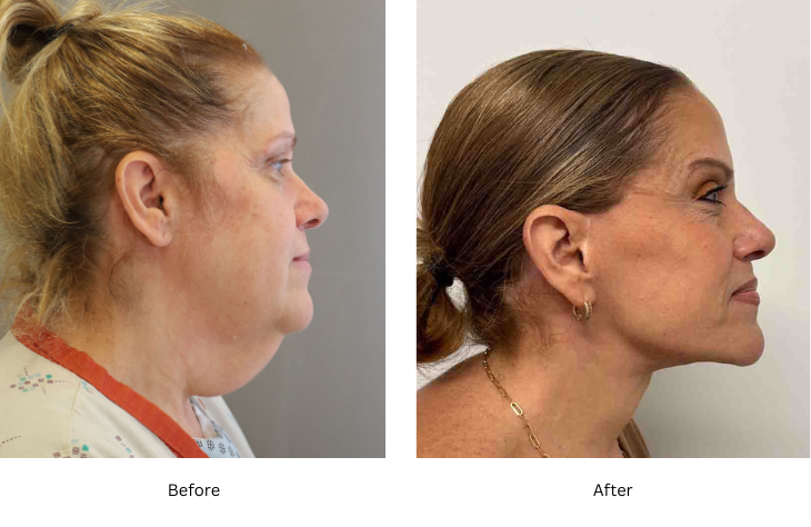 neck lift 5